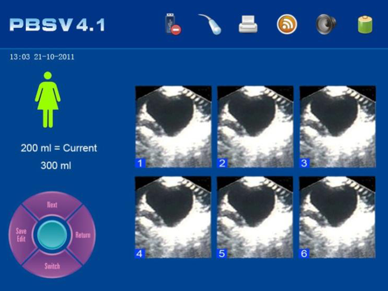 scanner vessie et résidu post mictionnel